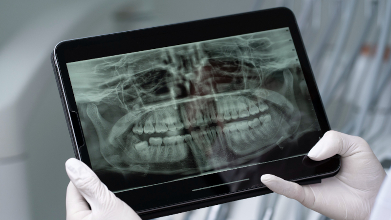 Saliva artificial com proteína da cana protege dentes de pacientes com câncer