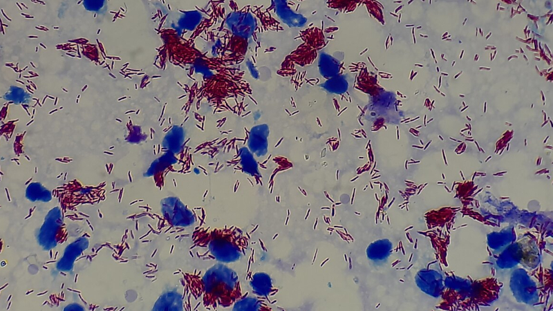 Exame de sangue e IA revolucionam diagnóstico precoce da hanseníase