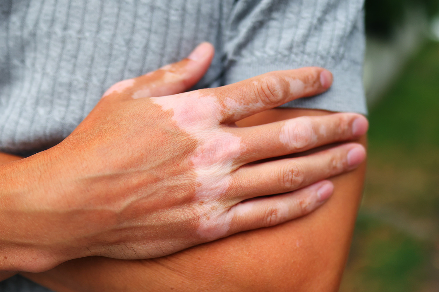 Genes Virais e Vitiligo: Estudo Revela Relação com Inflamação e Piora da Doença