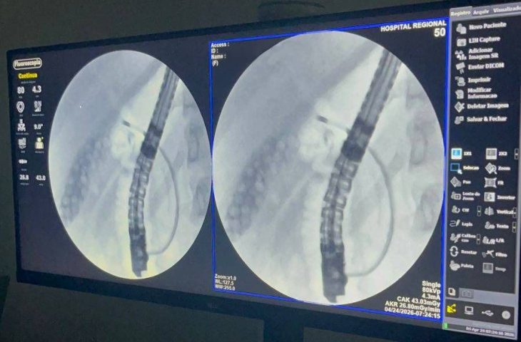 Hospital Regional de Dourados Realiza Primeira CPRE e Avança em Alta Complexidade
