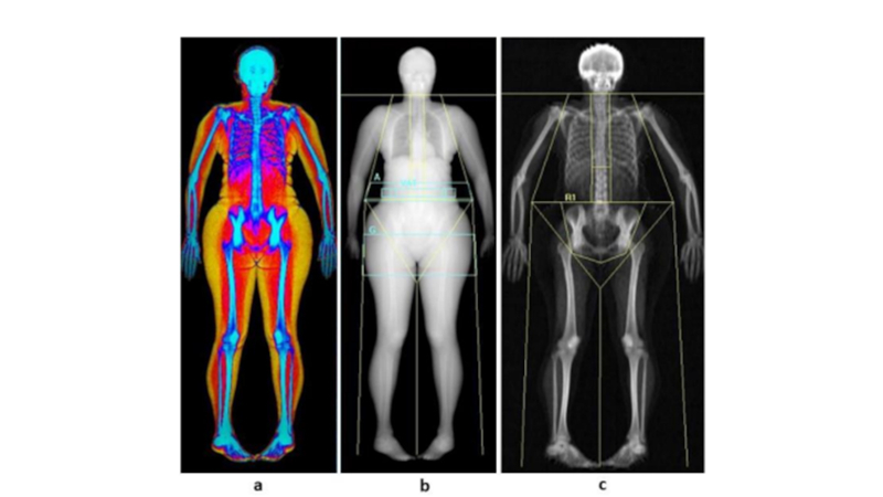 Gordura Abdominal Aumenta Risco de Incontinência Urinária em Mulheres